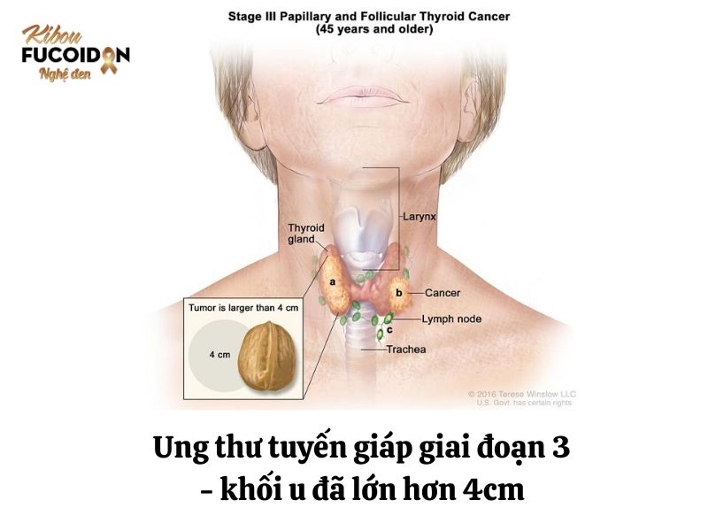 Hình ảnh minh hoa bệnh nhân K tuyến giáp giai đoạn 3 Hình ảnh minh hoa bệnh nhân K tuyến giáp giai đoạn 3
