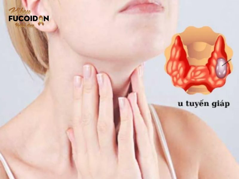 Bạn có biết: 7 loại ung thư có khả năng chữa khỏi? Ung thư tuyến giáp