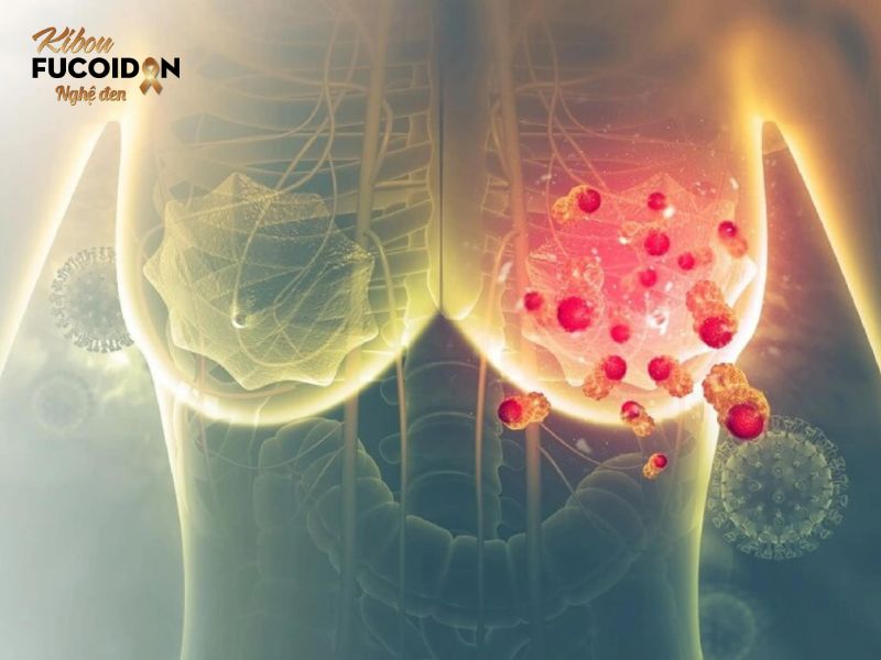 Bạn có biết: 7 loại ung thư có khả năng chữa khỏi? Ung thư vú