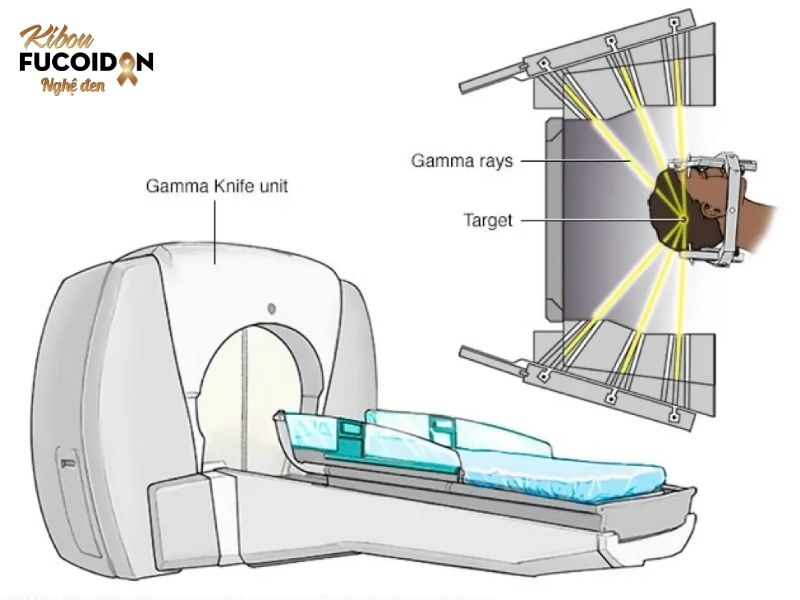 10 điều quan trọng cần nhớ về xạ trị ung thư Phương pháp xạ phẫu bằng dao