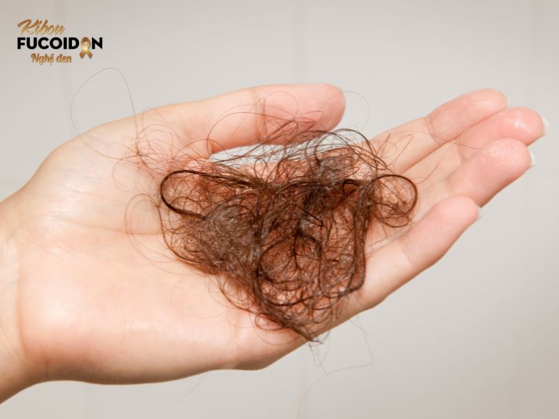 Rụng tóc là tác dụng phụ phổ biến của xạ trị ngoài ở vùng đầu và cổ