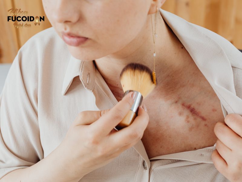 Sẹo là tác dụng phụ hiếm gặp của xạ trị ngoài