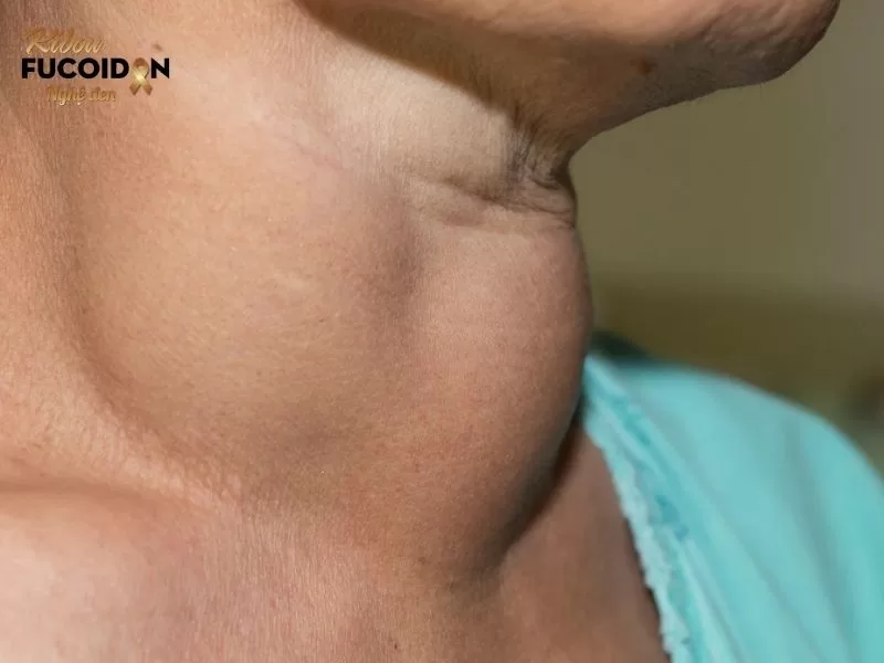 8 nguyên nhân ung thư tuyến giáp thường gặp và cách phòng ngừa Bệnh nhân măc các bệnh tuyến giáp như bướu cổ có nguy cơ cao mắc ung thư tuyến giáp