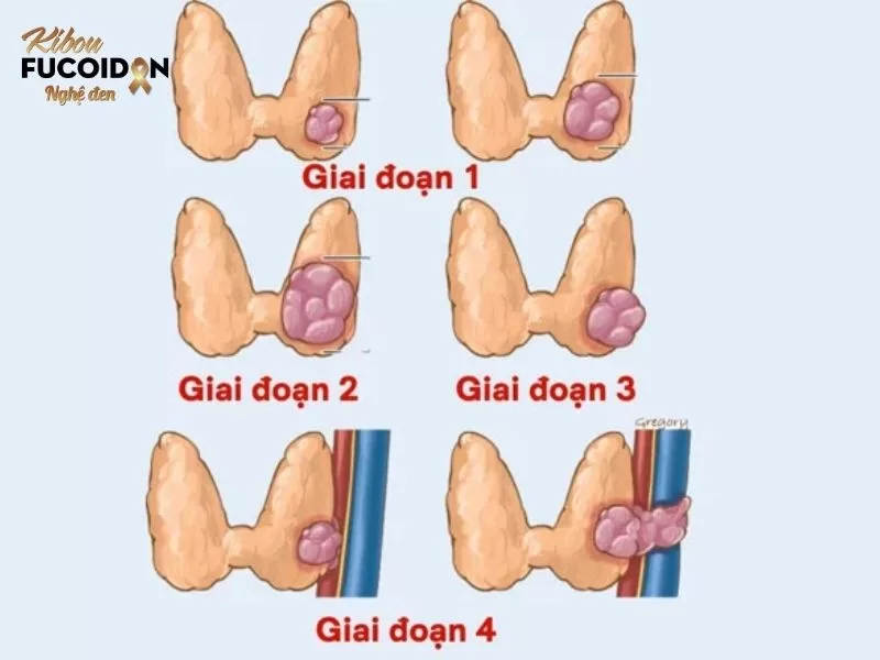 Các giai đoạn của ung thư tuyến giáp thể biệt hóa