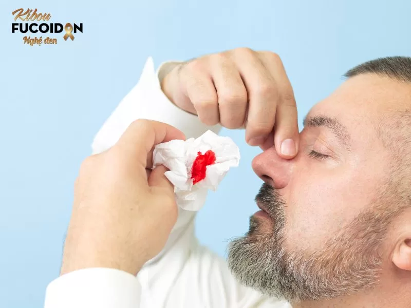 Chảy máu mũi không hẳn là dấu hiệu bệnh ung thư