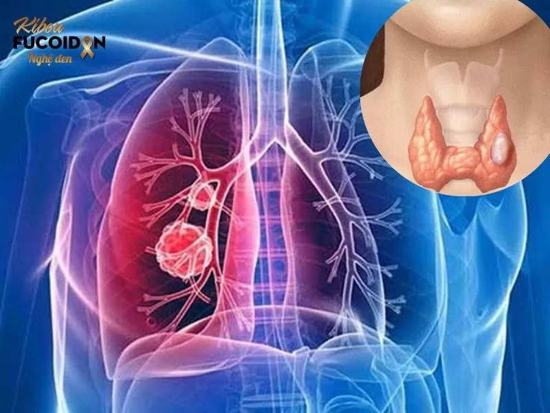 Ung thư tuyến giáp di căn và Những điều cần biết Ung thư tuyến giáp di căn phổi chiếm tới 84% các ca ung thư tuyến giáp di căn xa