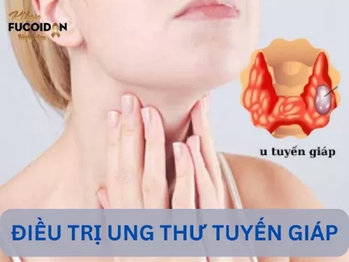 Chi tiết các cách điều trị ung thư tuyến giáp cho từng giai đoạn