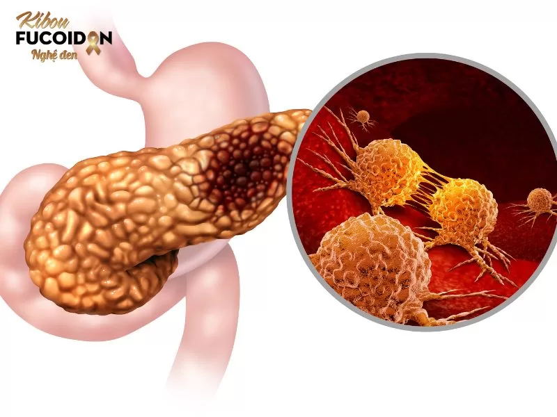 Ung thư có di truyền không? Làm sao khi mang gen di truyền ung thư Ung thư dạ dày không hoàn toàn di truyền, nhưng có thể có yếu tố di truyền trong một số trường hợp.