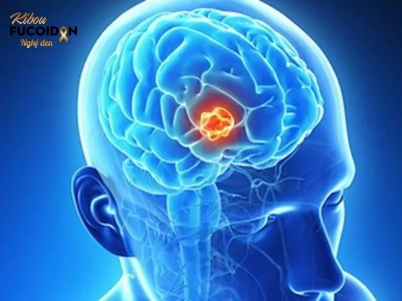 Ung thư nào chết nhanh nhất và nguy hiểm nhất? Ung thư não
