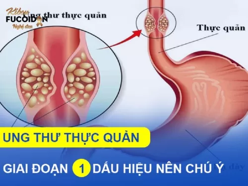 7 điều quan trọng về Ung thư thực quản giai đoạn 1