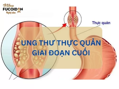Ung thư thực quản giai đoạn cuối - Mối nguy hiểm khó lường!