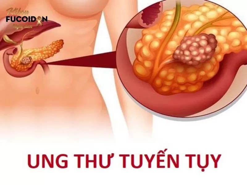 Ung thư nào chết nhanh nhất và nguy hiểm nhất? Ung thư tuyến tụy