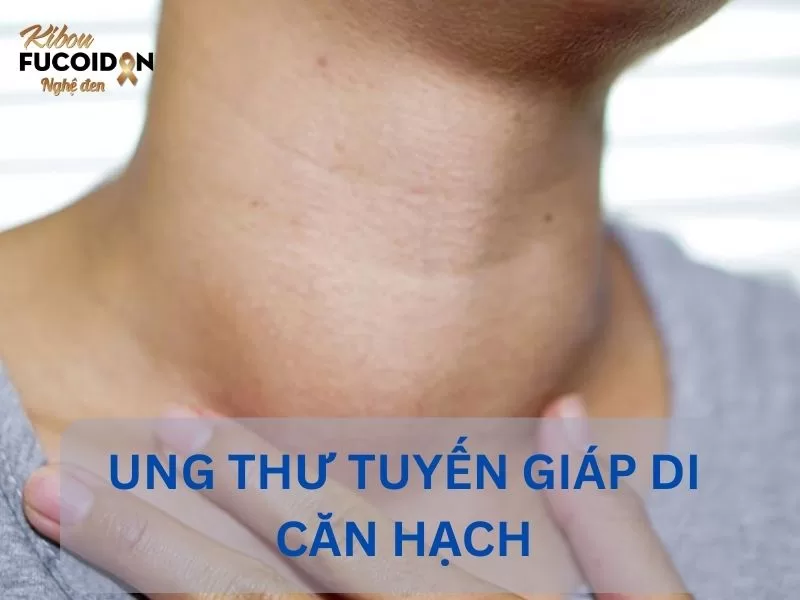 6+ điều quan trọng cần biết về Ung thư tuyến giáp di căn hạch Ung thư tuyến giáp di căn hạch là gì?