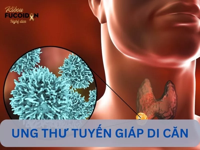 Ung thư tuyến giáp di căn và Những điều cần biết Ung thư tuyến giáp di căn là gì?