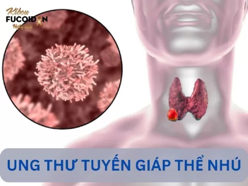 8 điều cần biết về Ung thư tuyến giáp thể nhú