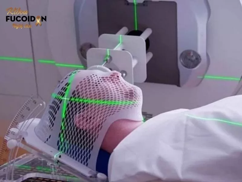 8 nguyên nhân ung thư tuyến giáp thường gặp và cách phòng ngừa Những bệnh nhân có tiền sử xạ trị vùng đầu cổ có nguy cơ cao mắc ung thư tuyến giáp