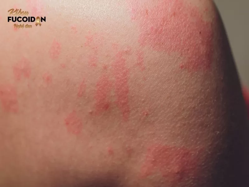 Câu trinh nữ hoàng cung có thể chữa dị ứng, mẩn ngứa