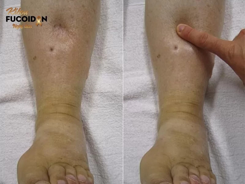 Nguyên nhân ung thư giai đoạn cuối bị phù chân và cách điều trị Vệt lõm sau khi ấn là căn cứ để chẩn đoán chứng phù chân ở người bệnh