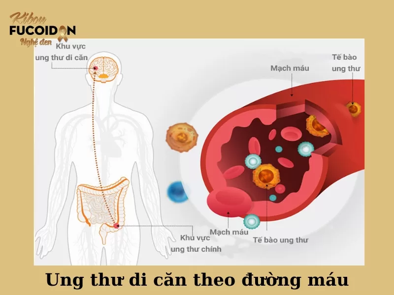 Ung thư di căn sống được bao lâu? Triệu chứng và cách điều trị Tế bào ung thư xâm nhập vào đường máu để di căn tới các cơ quan trong cơ thể