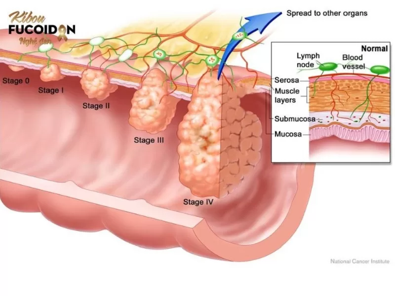 Những điều cần biết về các giai đoạn ung thư Hệ thống số phân loại các giai đoạn ung thư