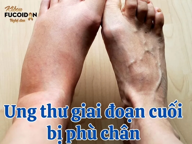 Nguyên nhân ung thư giai đoạn cuối bị phù chân và cách điều trị Tìm hiểu về tình trạng phù chân ở người ung thư giai đoạn cuối