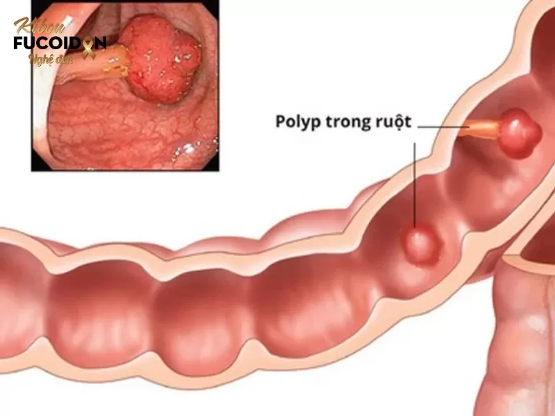 Tiền ung thư có phải là ung thư không? Dấu hiệu và cách điều trị Polyp đại tràng là một loại tổn thương tiền ung thư