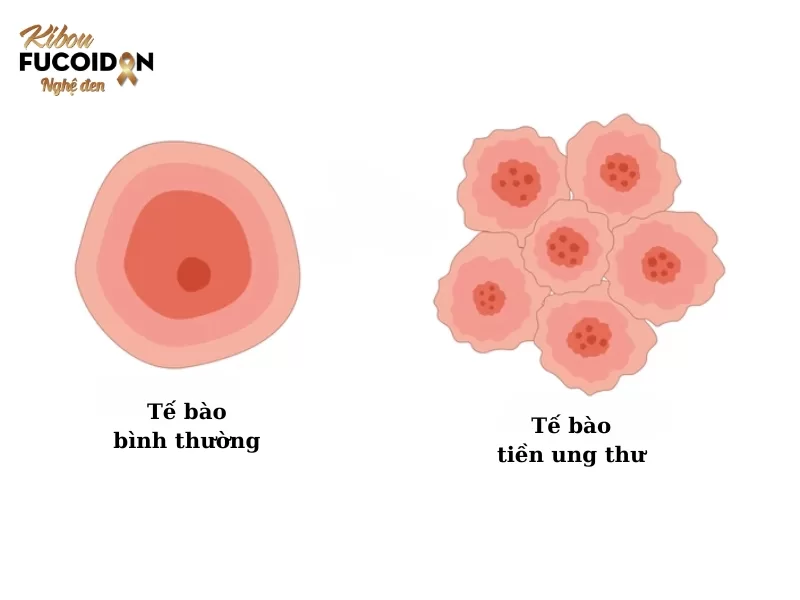 Tiền ung thư có phải là ung thư không? Dấu hiệu và cách điều trị Tiền ung thư là những tế bào phát triển bất thường