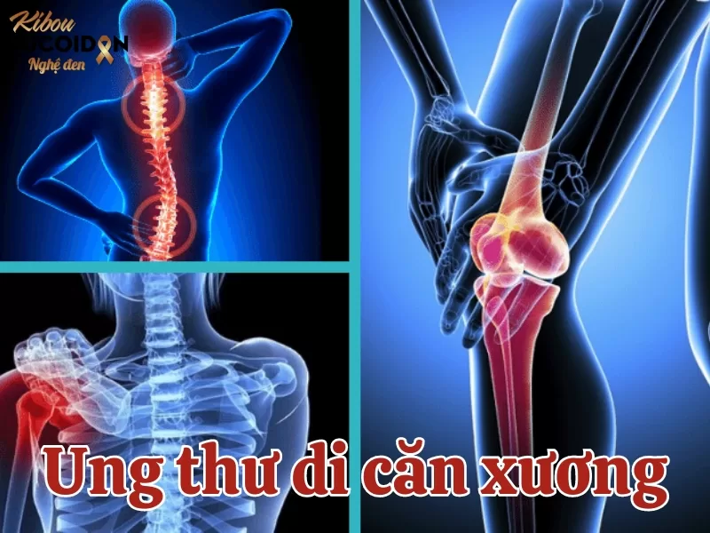 Tất tần tật về Ung thư di căn xương Ung thư di căn xương là gì?