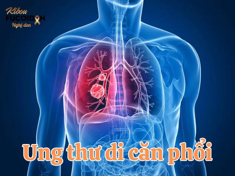 Những điều cần biết về ung thư di căn phổi Tìm hiểu về ung thư di căn phổi