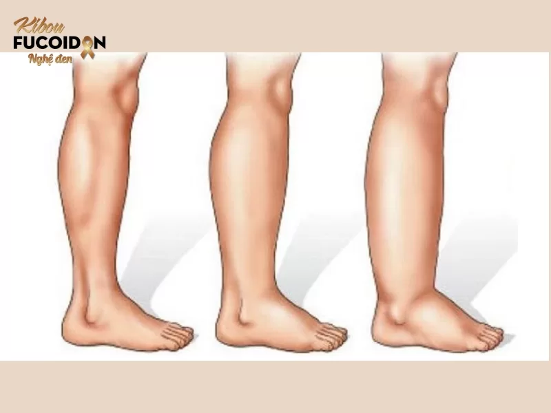 Nguyên nhân ung thư giai đoạn cuối bị phù chân và cách điều trị Chân sưng to là triệu chứng điển hình của phù chân