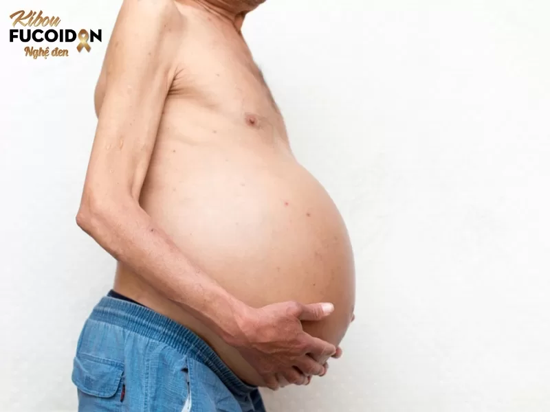 Ung thư di căn phúc mạc và những điều cần biết Cổ trướng