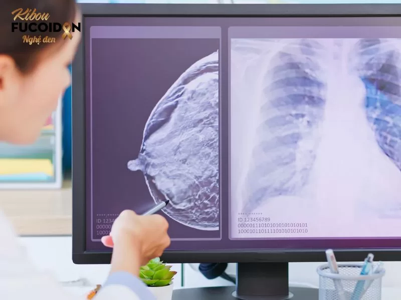 Ung thư vú là căn bệnh ung thư phổ biến nhất ở phụ nữ