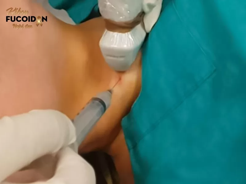 Triệu chứng, cách chẩn đoán và điều trị Ung thư di căn hạch Sinh thiết hach là phương pháp chính xác nhất giúp chẩn đoán ung thư di căn hạch