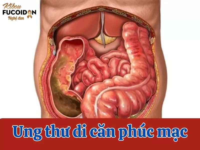 Ung thư di căn phúc mạc và những điều cần biết Tìm hiểu về ung thư di căn phúc mạc