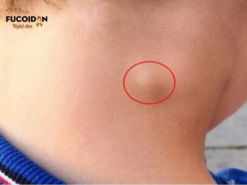Triệu chứng, cách chẩn đoán và điều trị Ung thư di căn hạch Khi ung thư di căn tới hạch nào thì hạch đó sẽ trở nên cứng và sưng lên