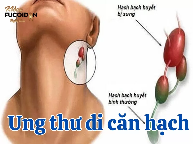 Triệu chứng, cách chẩn đoán và điều trị Ung thư di căn hạch Ung thư di căn hạch là gì?