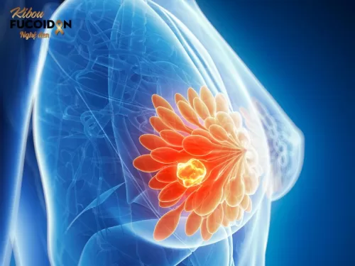 Ung thư vú là loại ung thư phổ biến nhất ở phụ nữ trên toàn thế giới