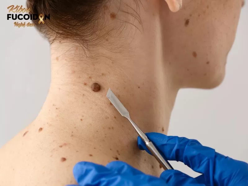Dấu hiệu nhận biết nốt ruồi ung thư? Hình ảnh nốt ruồi trên da