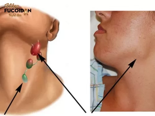 Tổng quan về u lympho