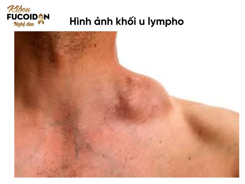 Sưng hạch bạch huyết là triệu chứng phổ biến nhất của u lympho