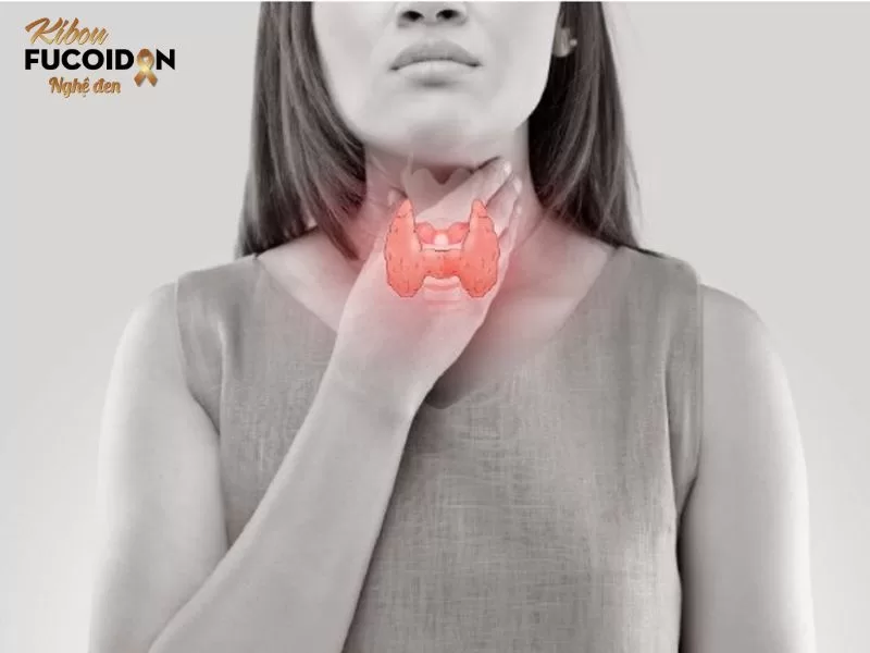 Vôi hóa tuyến giáp có nguy hiểm không Vôi hóa tuyến giáp là hiện tượng lắng đọng muối canxi trong các mô của tuyến giáp