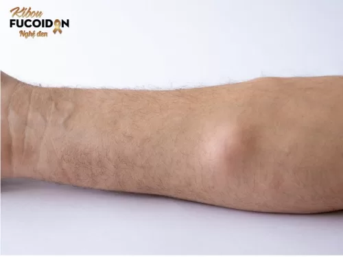 U mỡ thường mềm khi sờ vào
