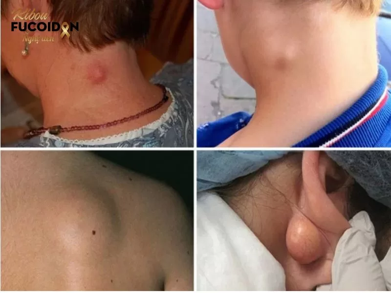 U bã đậu là bệnh gì? Có nguy hiểm không? U bã đậu thường không gây đau đớn, chỉ gây khó chịu khi u phát triển to