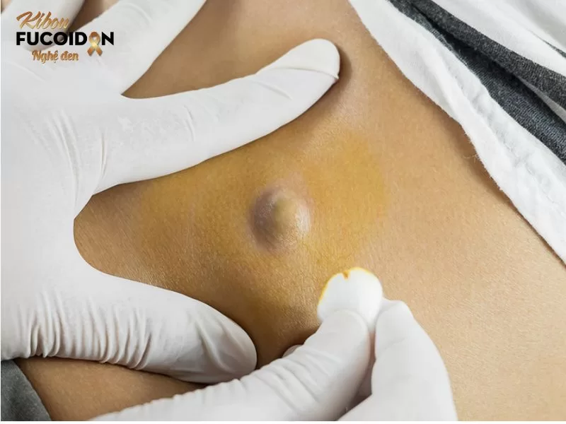 U bã đậu là bệnh gì? Có nguy hiểm không? U bã đậu cũng không tự hết mà cần có sự can thiệp như tiểu phẫu u bã đậu