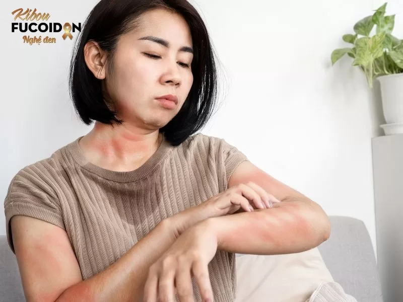 Ngứa da có thể do sự tích tụ bilirubin trong máu hoặc do da bị khô do chức năng gan suy giảm.