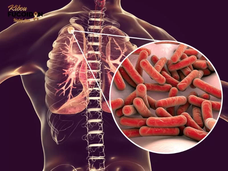 Các khối u ác tính trong phổi làm tổn thương mạch máu, dẫn đến ho ra máu.