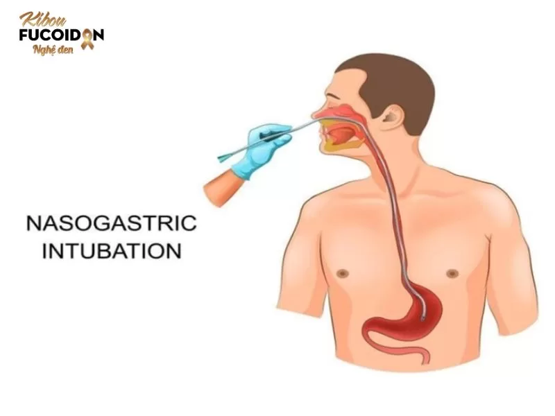 Ống thông dạ dày là gì? Chăm sóc bệnh nhân đặt ống thông dạ dày ra sao? Hình ảnh minh họa bệnh nhân được đặt ống thông dạ dày