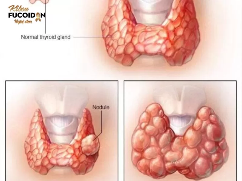 Phình giáp là bệnh gì? Phình giáp có nguy hiểm không? Phình giáp đa hạt là tình trạng tuyến giáp to lên bất thường và xuất hiện nhiều nhân