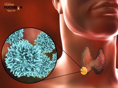 Carcinoma tuyến giáp thể nhú là một trong những loại ung thư tuyến giáp phổ biến nhất