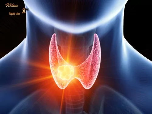 Bệnh suy giáp (hypothyroidism) là một tình trạng mà tuyến giáp không sản xuất đủ hormone cần thiết cho cơ thể